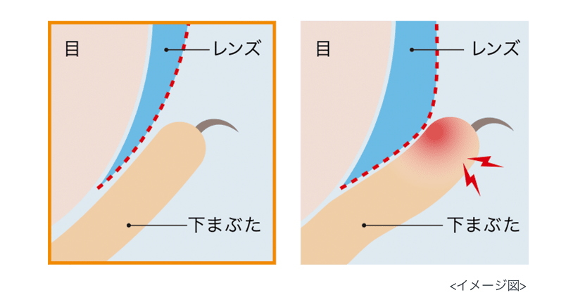 ワンデーアキュビューモイスト乱視用エッジデザイン